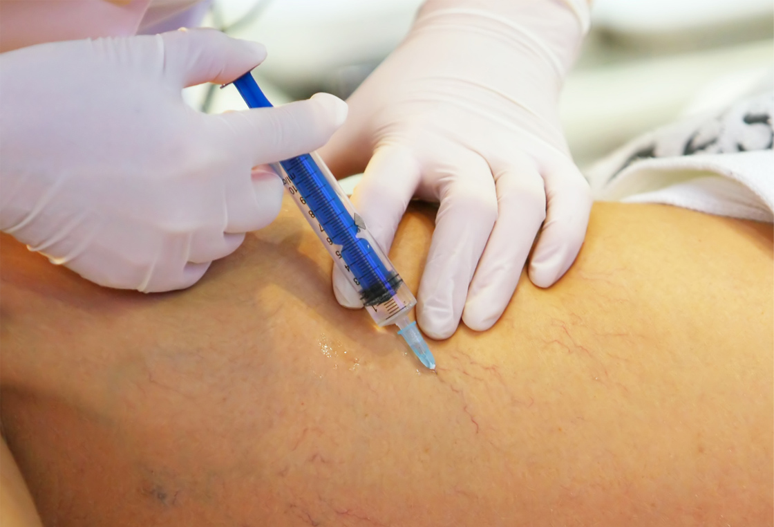 Como funciona a escleroterapia para o tratamento de varizes?