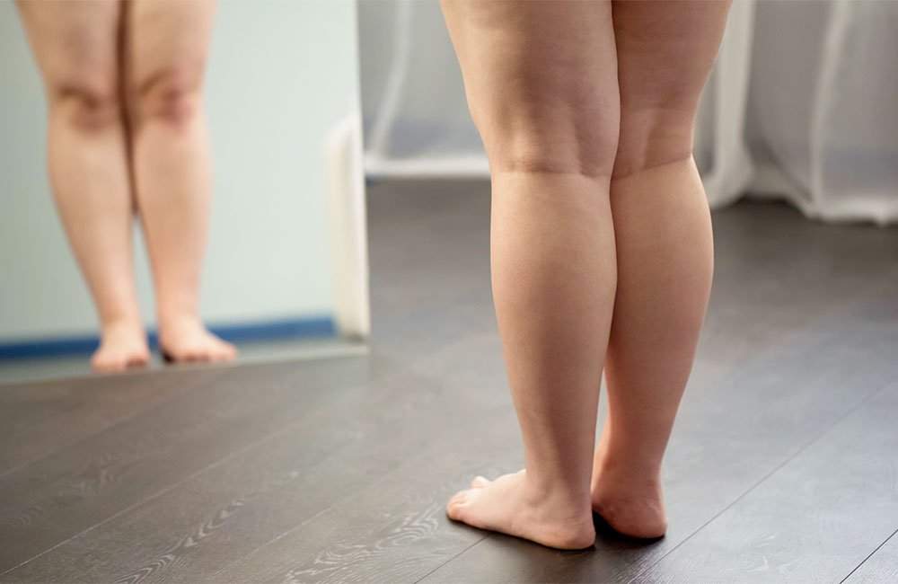 Lipedema é o mesmo que obesidade? - CLÍNICA VITTÁ